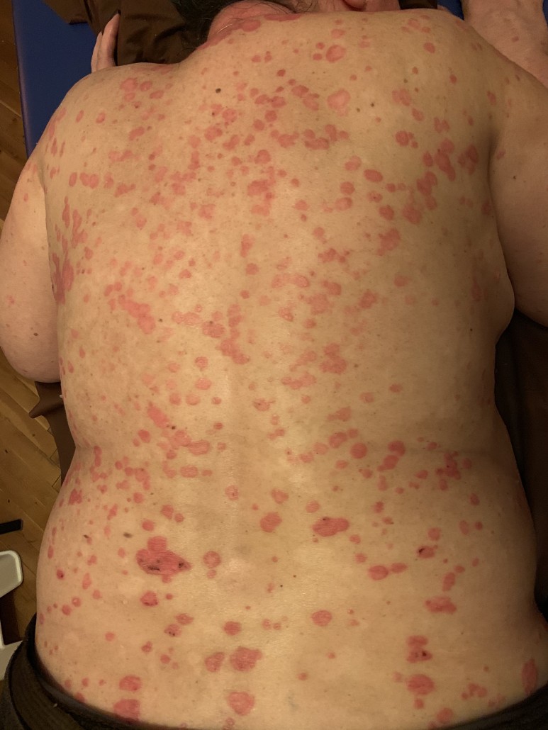 pikkelysömör kezelése népi vörös allergén foltok az arcon