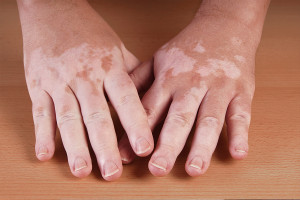 vitiligo és pajzsmirigy alulműködés